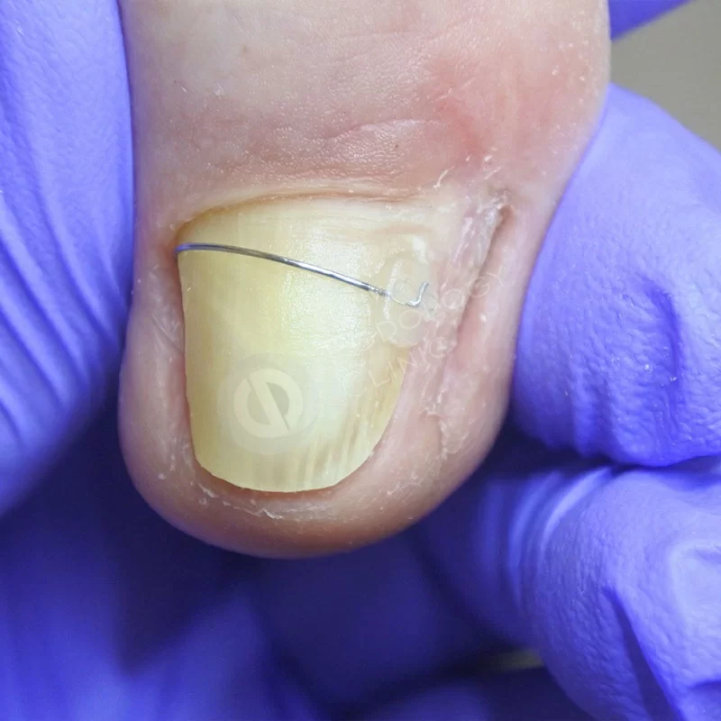 Лечение вросшего ногтя на ноге клиника thumbnail