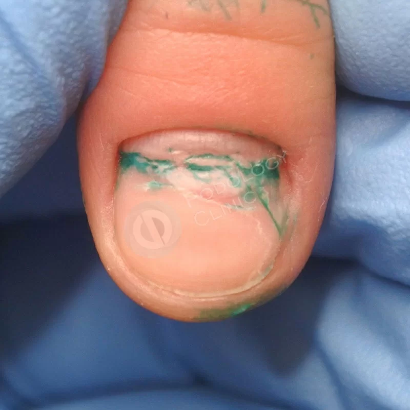 Повреждение ногтевой пластины как вылечить thumbnail