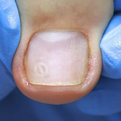 Клиники лечение грибка ногтей ног