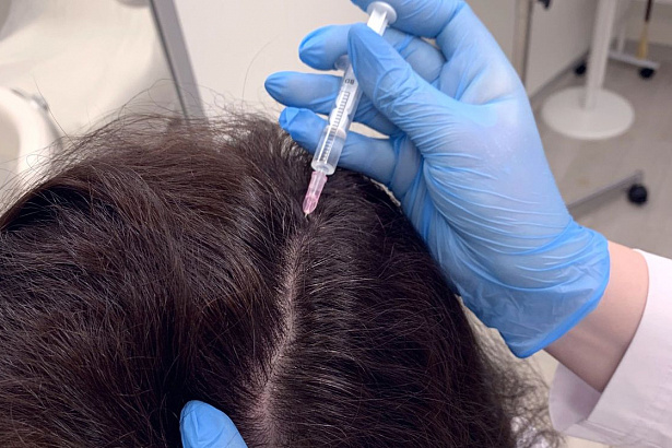 Мезотерапия в лечении волос