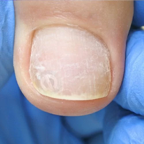 Лечение вросших ногтей на ногах в москве
