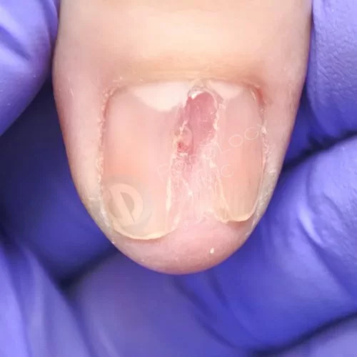 Травма ногтевого ложа на ноге лечение
