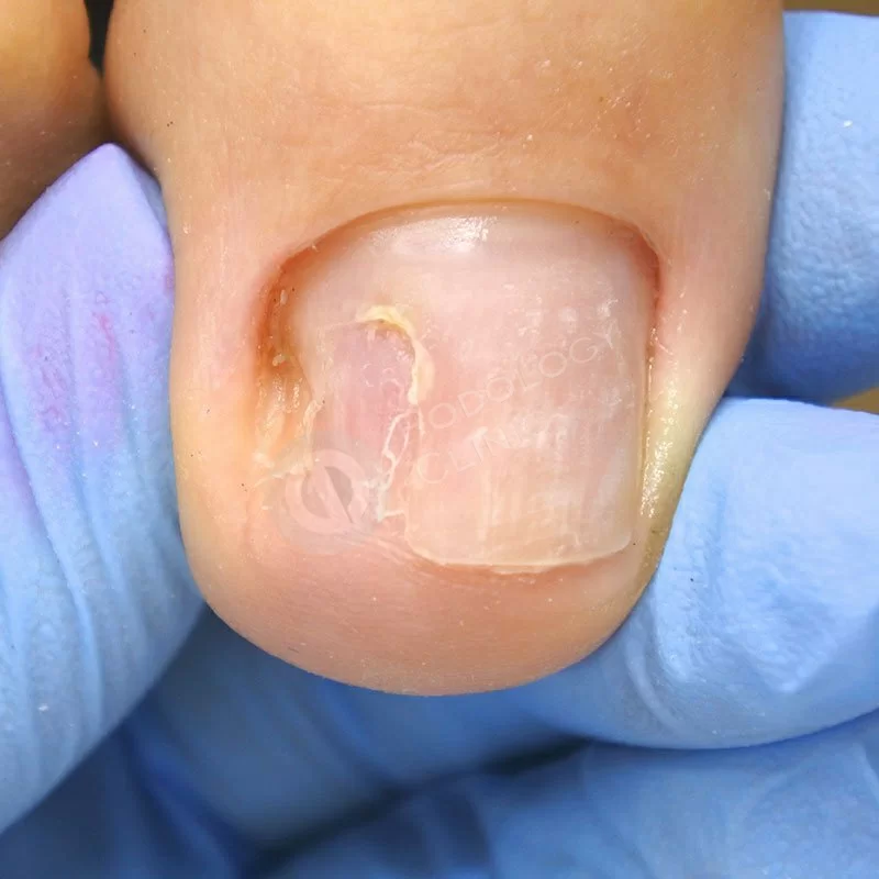 Центр лечение грибка ногтей на ногах