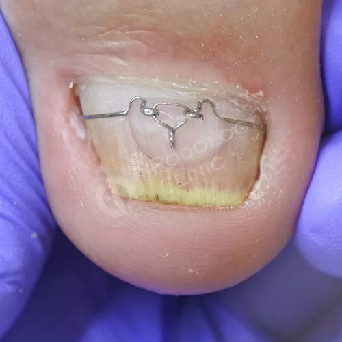 Грибок ногтей на ногах лечение адреса thumbnail