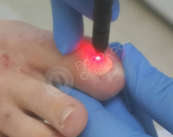 Удаление лазером ногтя при сахарном диабете