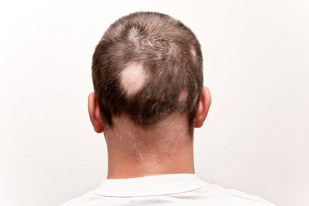 Клинический опыт комбинированной терапии микроспории волосистой части головы