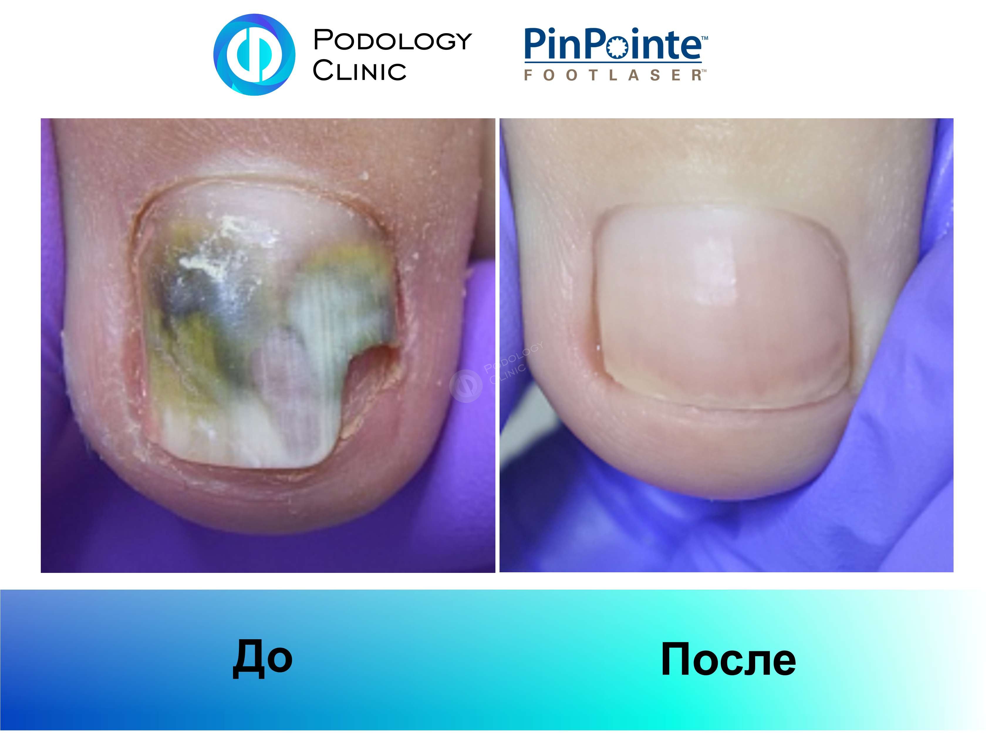 Примеры работы лазера PinPointe FootLaser в лечении онихомикоза, фото 3