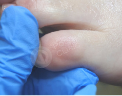 Удаление мозолей между пальцев ног лазером