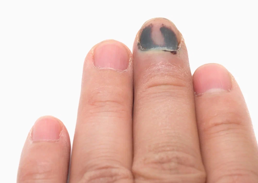 Травма ногтя на пальце руки